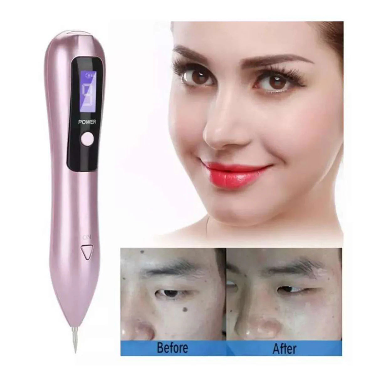 Cauterizador Suizo – Removedor de Verrugas y Lunares