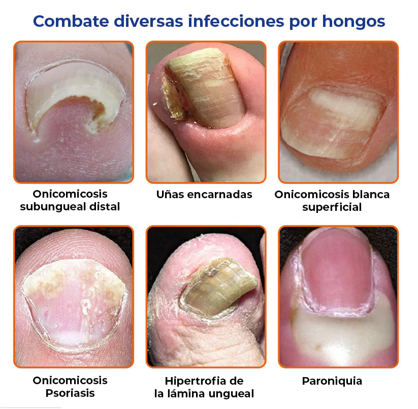 MyCare® |ELIMINA LOS HONGOS DE LAS UÑAS EN 5 DÍAS Y EVITA QUE APEREZCAN PARA SIEMPRE