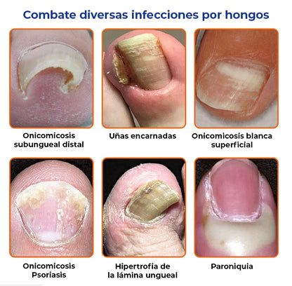 MyCare® |ELIMINA LOS HONGOS DE LAS UÑAS EN 5 DÍAS Y EVITA QUE APEREZCAN PARA SIEMPRE