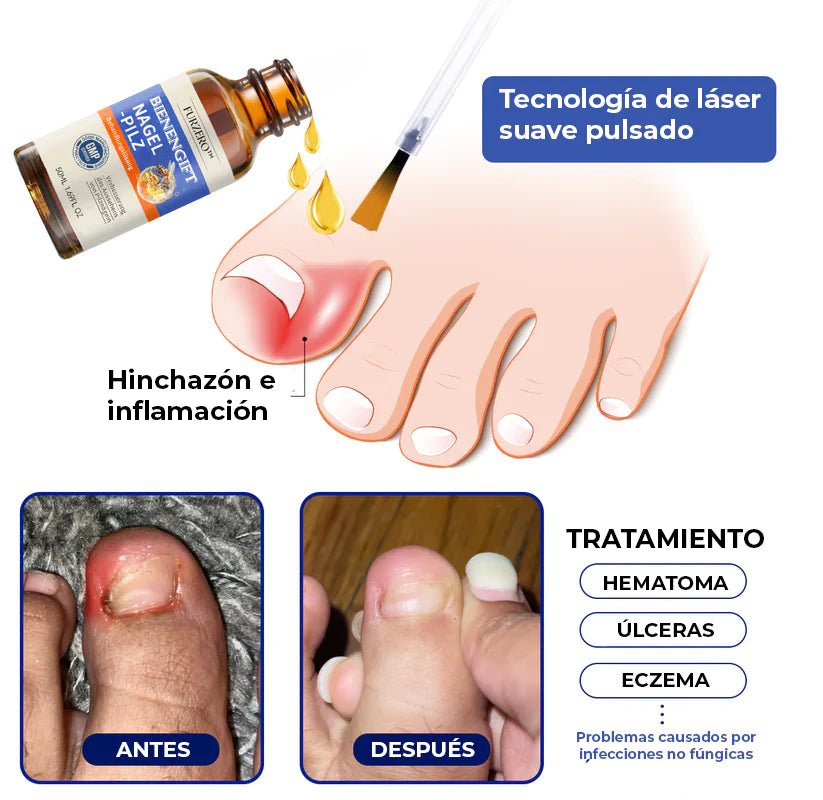 MyCare® |ELIMINA LOS HONGOS DE LAS UÑAS EN 5 DÍAS Y EVITA QUE APEREZCAN PARA SIEMPRE