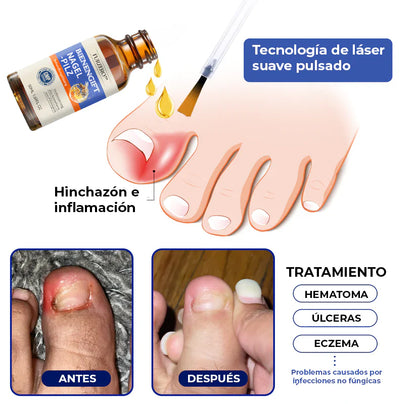 MyCare® |ELIMINA LOS HONGOS DE LAS UÑAS EN 5 DÍAS Y EVITA QUE APEREZCAN PARA SIEMPRE